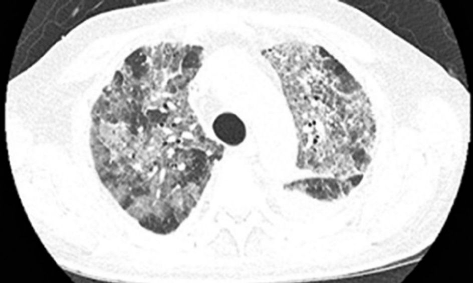 担心免疫治疗副作用?“早”字是关键!