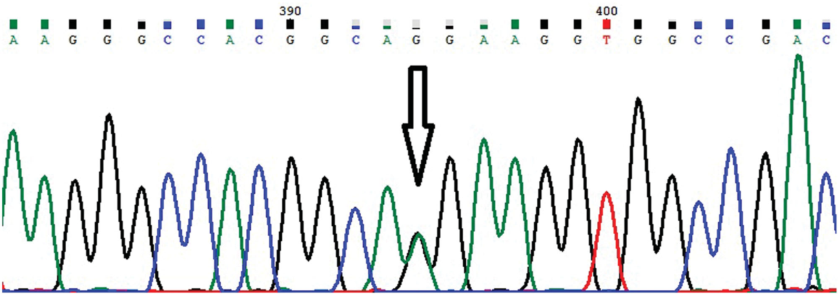 MALDI-TOF质谱再次鉴定出新型变异血红蛋白