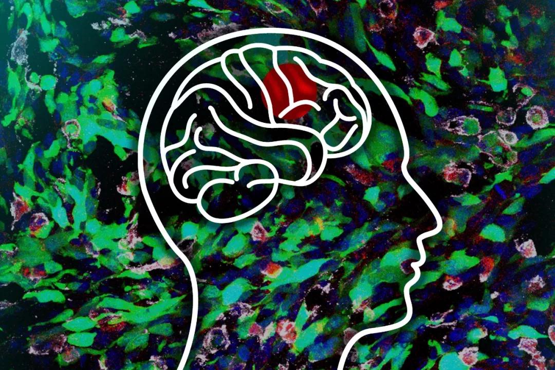 【Nature子刊】抑制负责发展为癌细胞的基因，使脑癌细胞易受化疗影响！