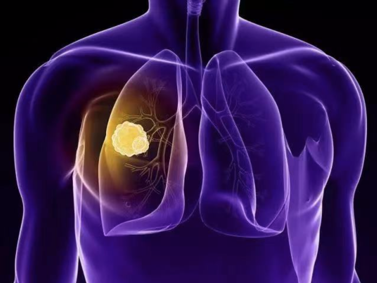 【柳叶刀子刊】南医大沈洪兵、胡志斌教授团队首次提出mCAs可作为一类新型基因组标志物预测肺癌的发病风险