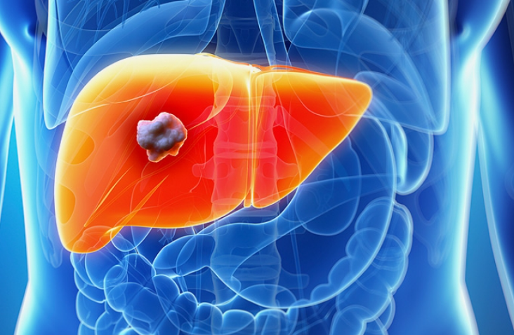 【Gut】中山大学联合哈佛医学院揭示原发性和复发性肝癌的免疫微环境及助力免疫治疗