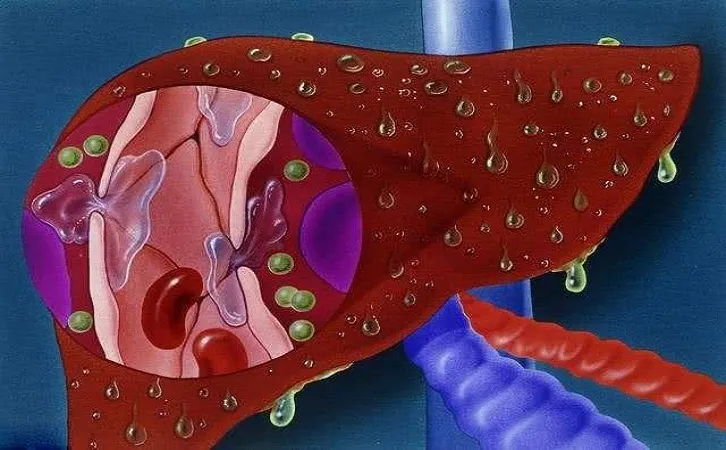  【STTT】这种抗过敏药有望抗癌！广州医科大学李斌团队发现肝癌新治疗靶点