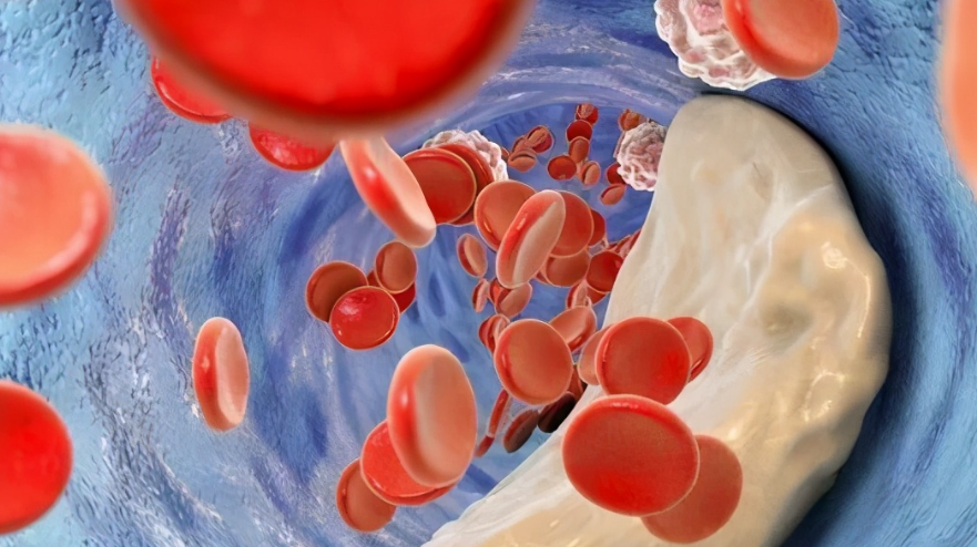 【柳叶刀子刊】血脂异常，或为新冠后遗症！