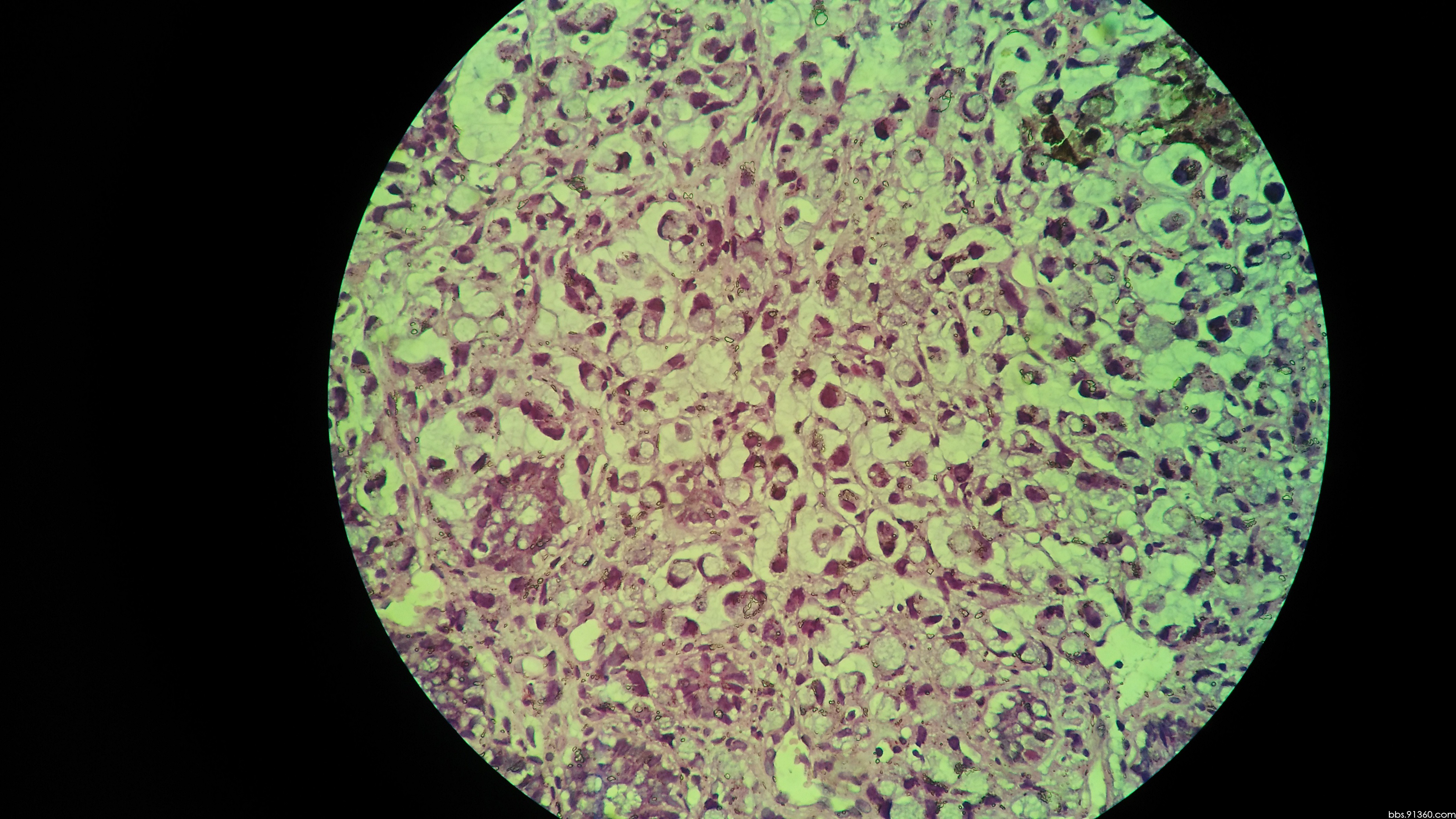 中山大学肿瘤防治中心最新研究证实：新辅助免疫治疗显著改善对结直肠癌的长期疗效