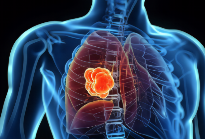 【Science子刊】南京大学殷武教授课题组揭示非小细胞肺腺癌免疫逃逸新机制