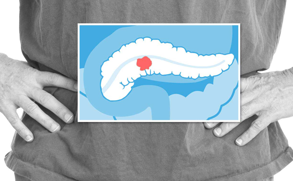 【Nature子刊】重磅综述：“癌症之王”胰腺癌的新辅助治疗策略