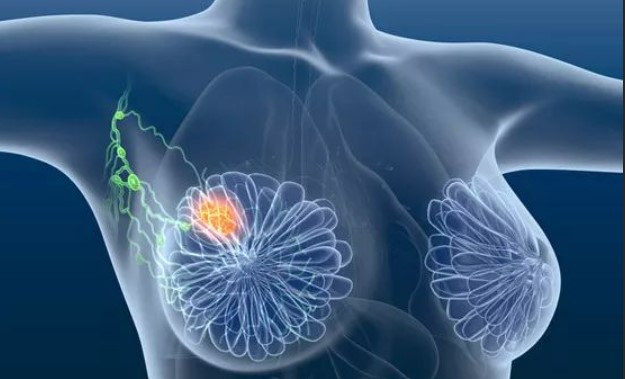 复旦团队再突破！邵志敏、江一舟、王中华基于亚分型的平台指导预处理转移性三阴性乳腺癌的精准医疗