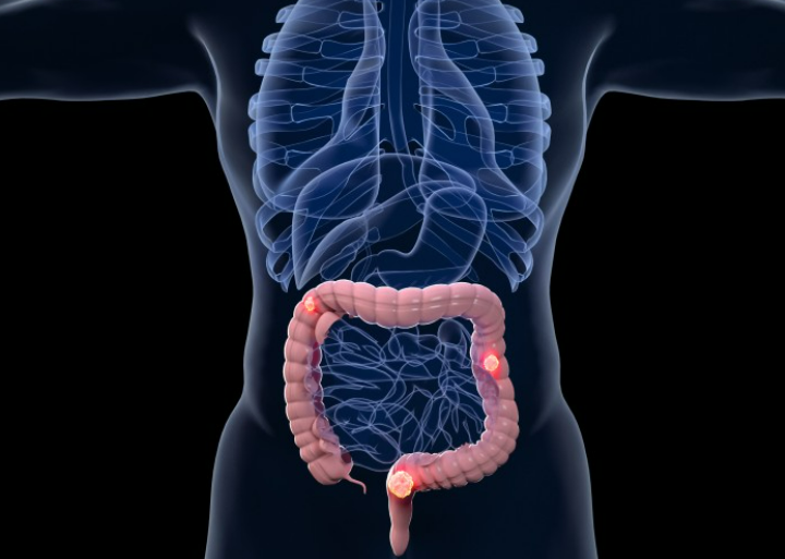 【Nature子刊】上海交通大学研究：花生四烯酸通过调节肠道微生态促进结直肠癌进展