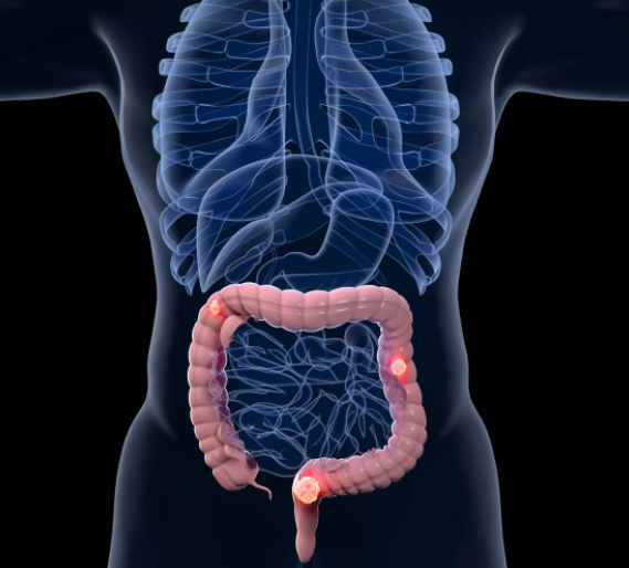 【Cancer Cell】中山大学邓艳红团队揭示ICI治疗的潜在靶点