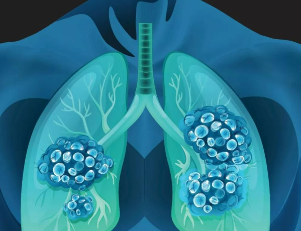 上海交通大学姚烽等团队合作开发新的纳米颗粒，诱导肺癌细胞焦亡