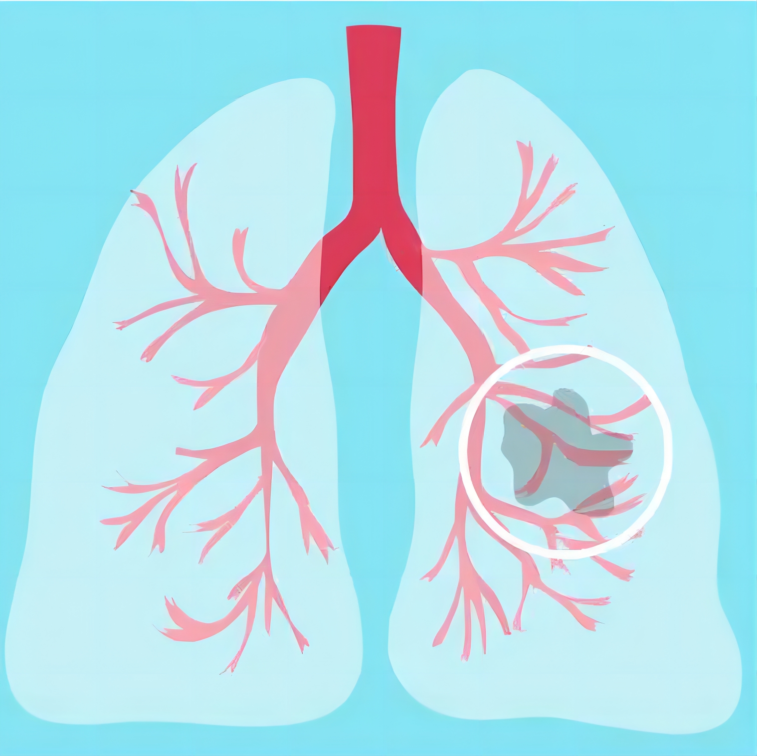 【Nature子刊】实锤了！共36种！哈佛医学院合作发现吸烟相关肺癌诊断前生物标志物