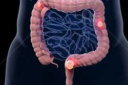 《npj Precision Oncology》慕尼黑大学建立帮助优化结直肠癌治疗的全新模型