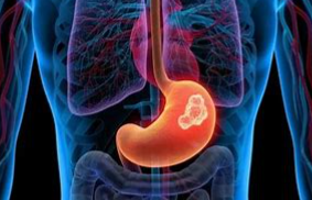 揭示胃癌转移的内在机制！海军军医大学发现潜在治疗靶点！