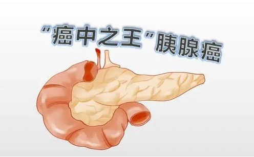 重磅！天津医科大学发现胰腺癌治疗新靶点