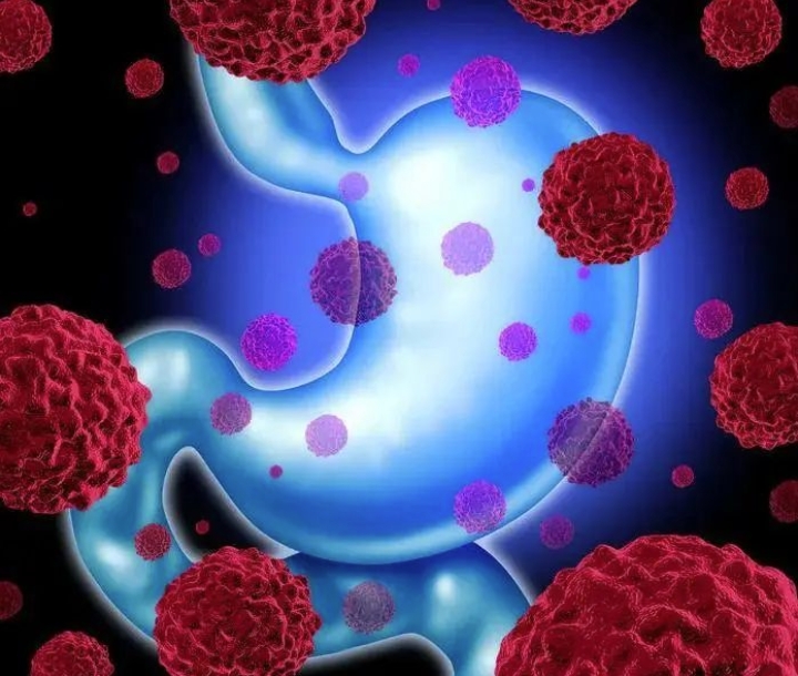 新发现！中山大学发现胃癌治疗新靶点 揭示治疗新策略