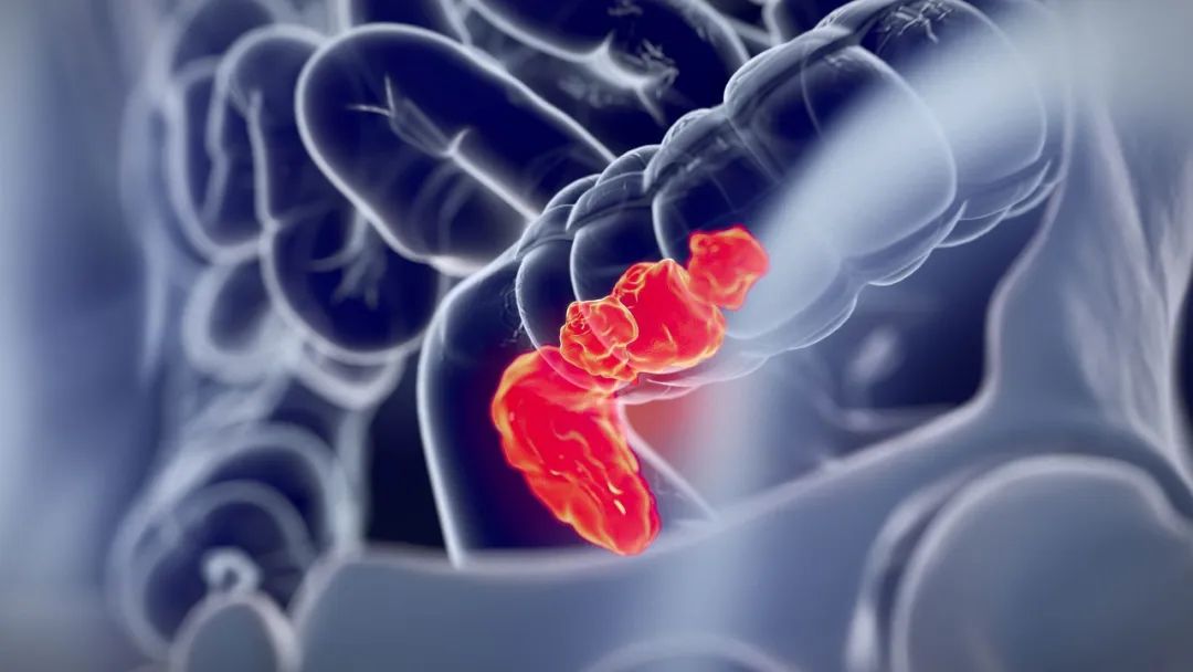重大突破！苏州大学发现结直肠癌治疗新药 开发治疗新策略