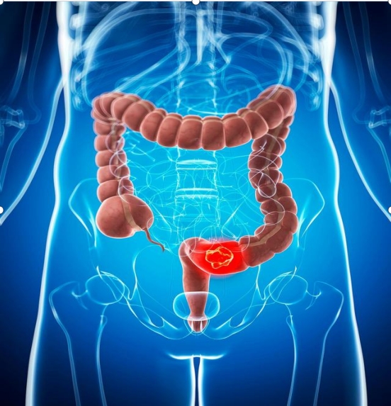 可抑制结直肠癌转移！上海交通大学严东旺/赵倩团队发现结直肠癌治疗新靶点
