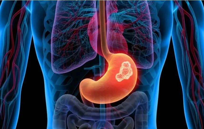 再取进展！南京大学等团队合作揭示胃癌进展最新分子机制和治疗靶点