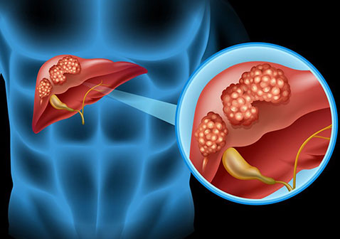 【Cell子刊】天津医科大学最新研究：发现加重肝癌侵袭性和免疫治疗耐药性新机制