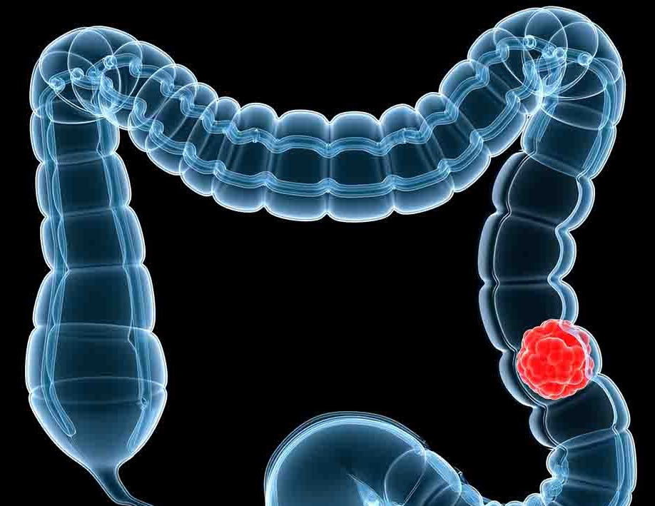 【Adv. Sci.】武汉大学中南医院揭示结直肠癌最新治疗选择