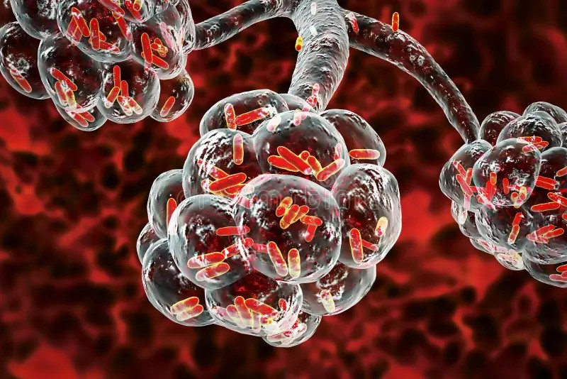 细菌性肺炎的免疫全景图：中国人民解放军总医院与首都儿研所等合作的单细胞转录组研究