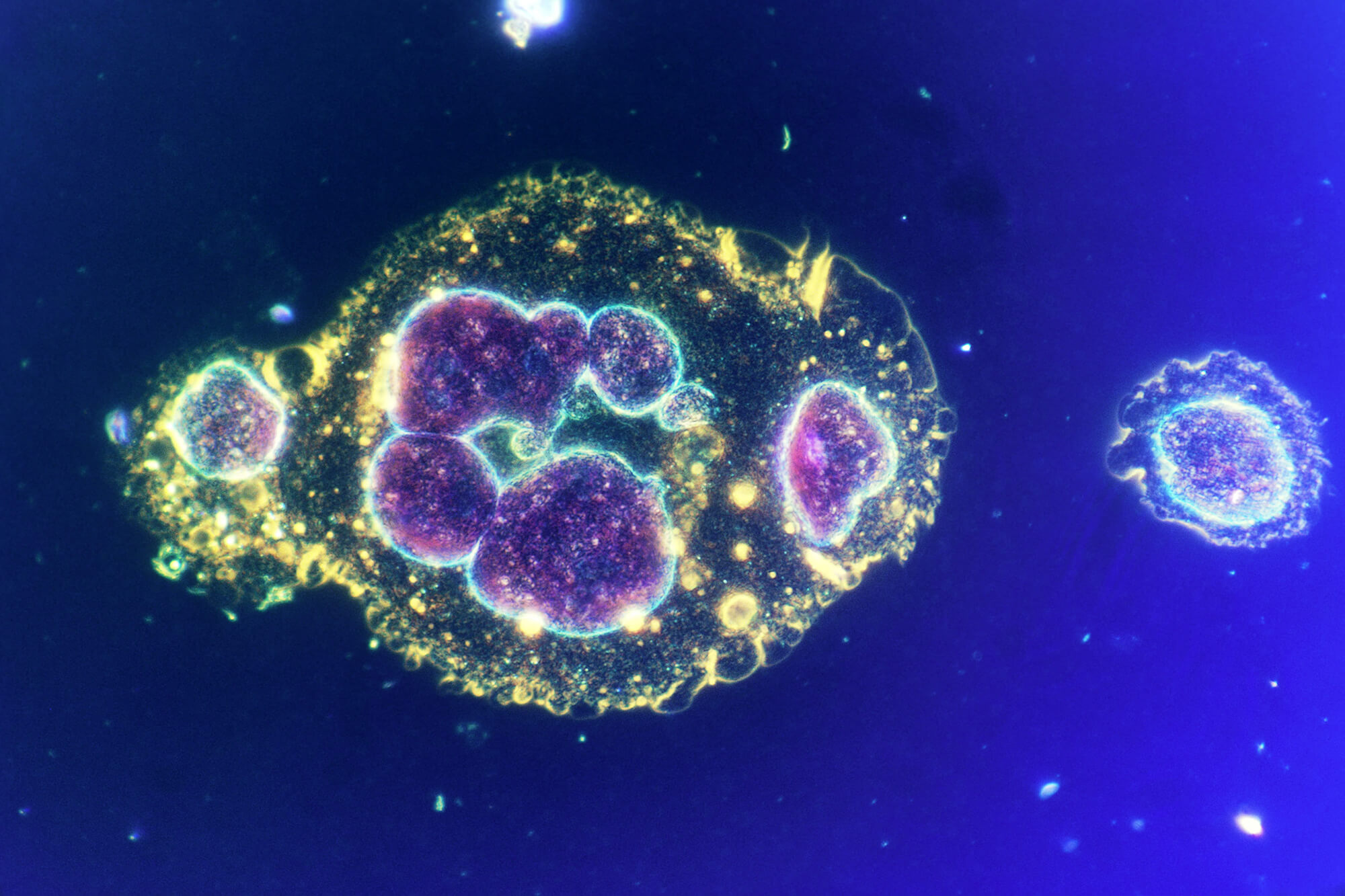 滤泡性淋巴瘤耐药不再难治！瑞金医院双靶向疗法显神威