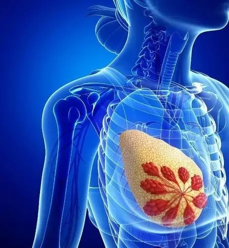 诱导铁死亡！温州医科大学研究团队：内分泌疗法耐药的乳腺癌患者新的治疗选择