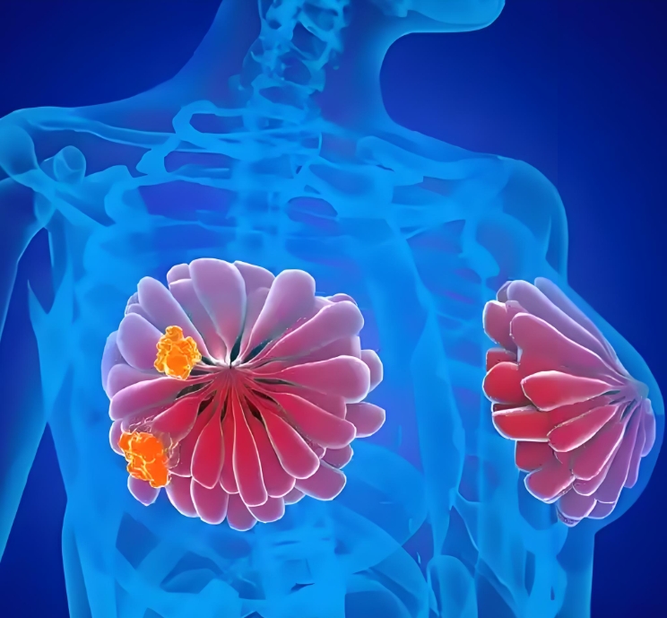 加速自噬！南昌大学/南方科技大学合作发文：乳腺癌的特异性生物标志物和潜在治疗靶点