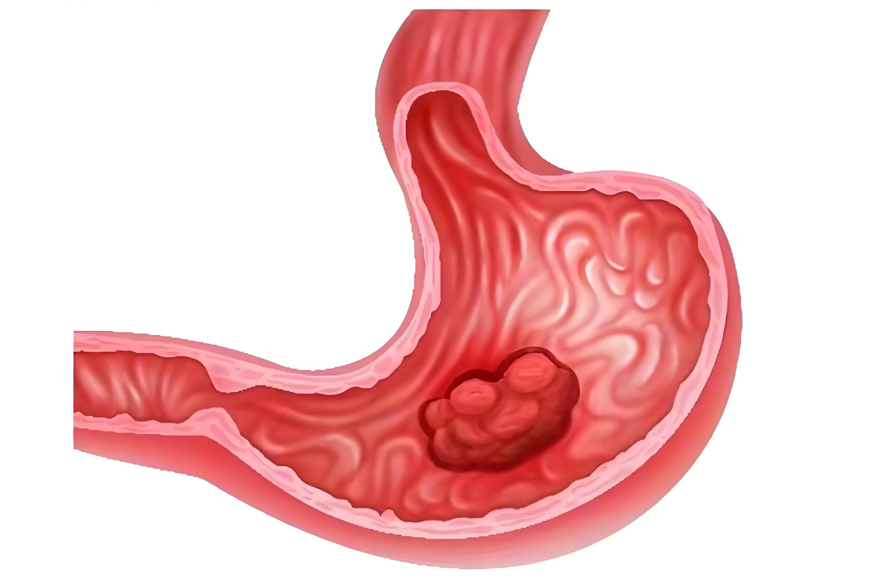 华南理工大学/中山大学联合揭秘：胃癌转移新机制，锁定潜在治疗靶点