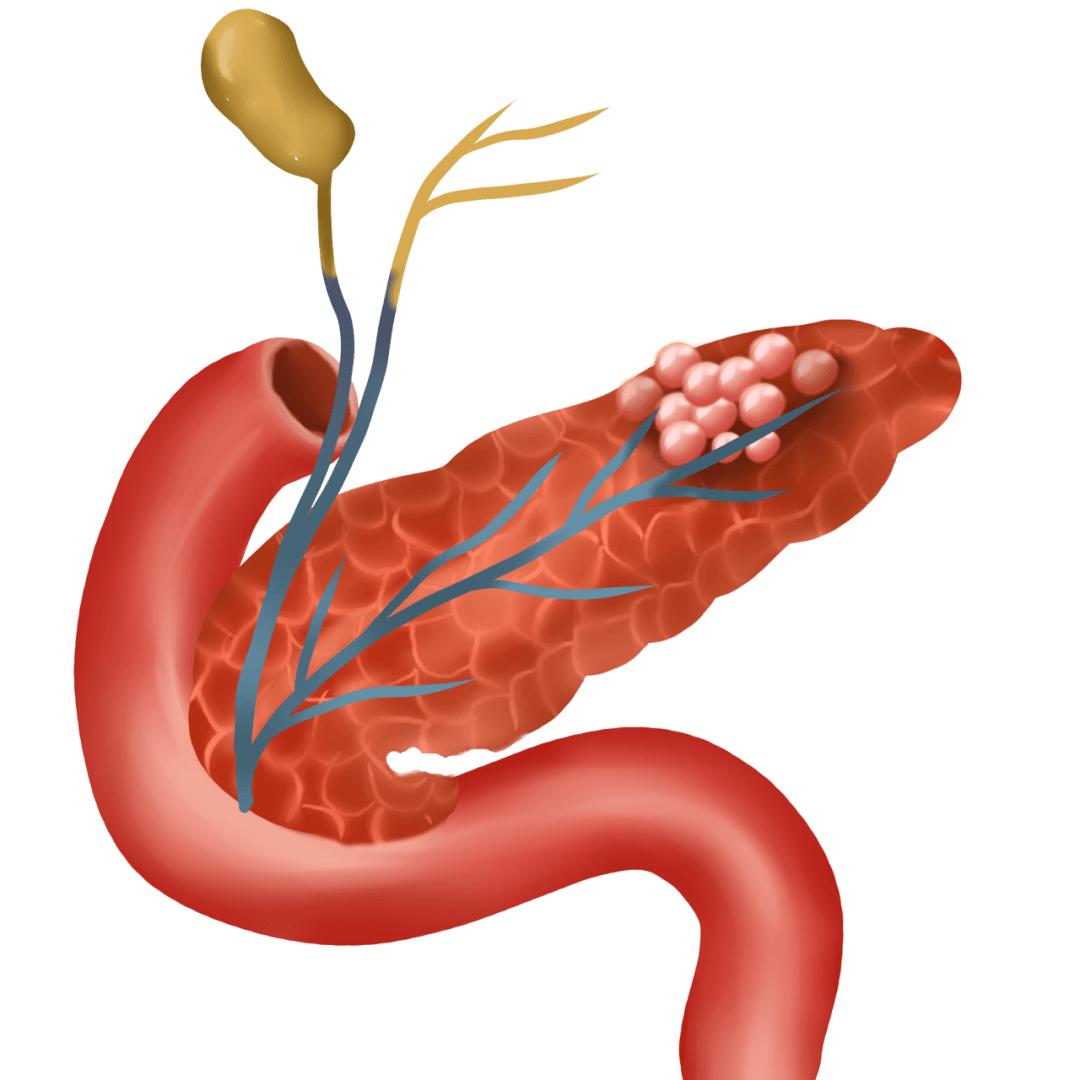 攻克“癌王”新武器！中山大学/深圳大学研究团队提出胰腺癌靶向治疗新方案