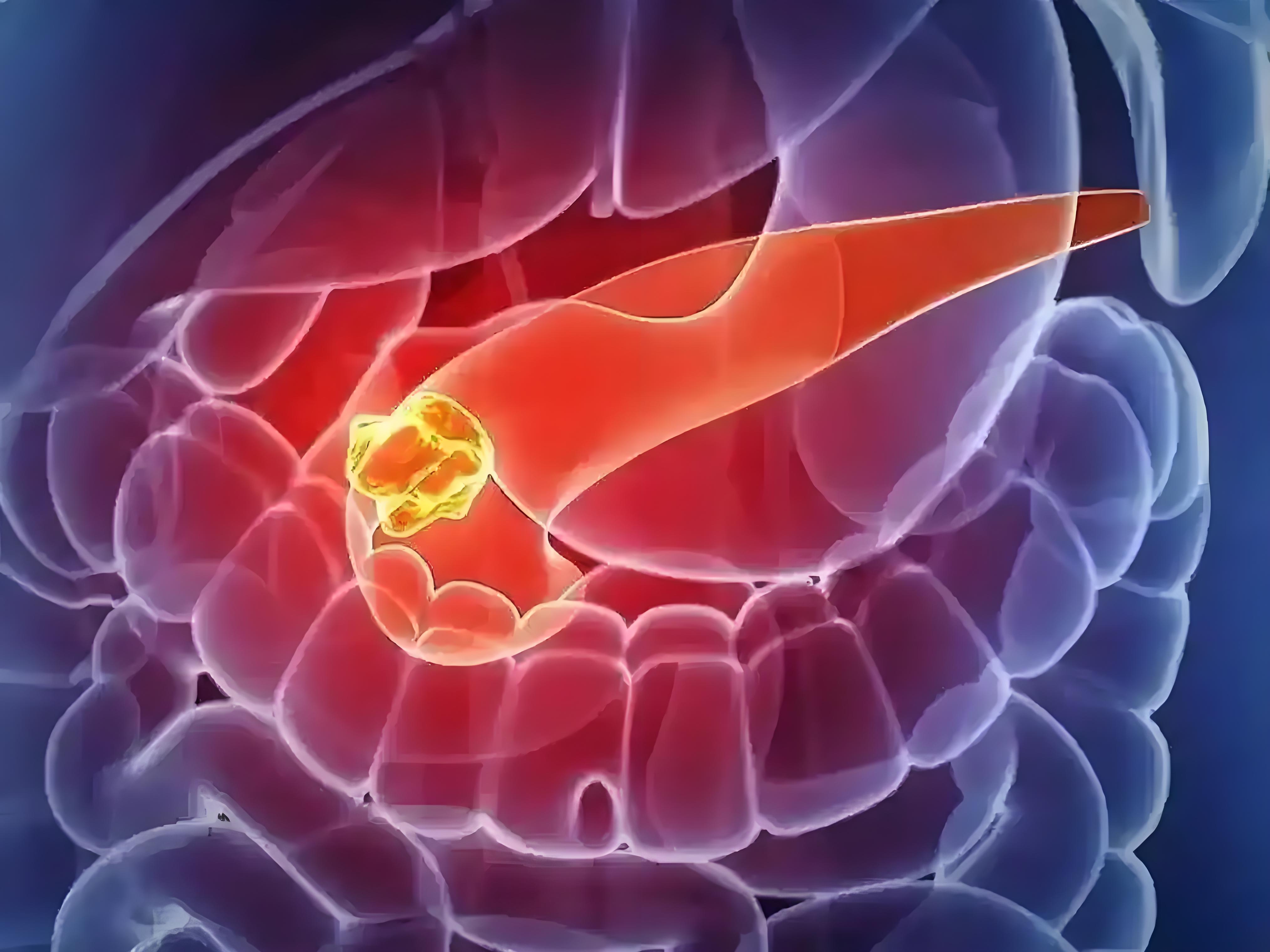 填补空白！哈尔滨医科大学发文：抑制胰腺癌细胞恶性行为的新机制