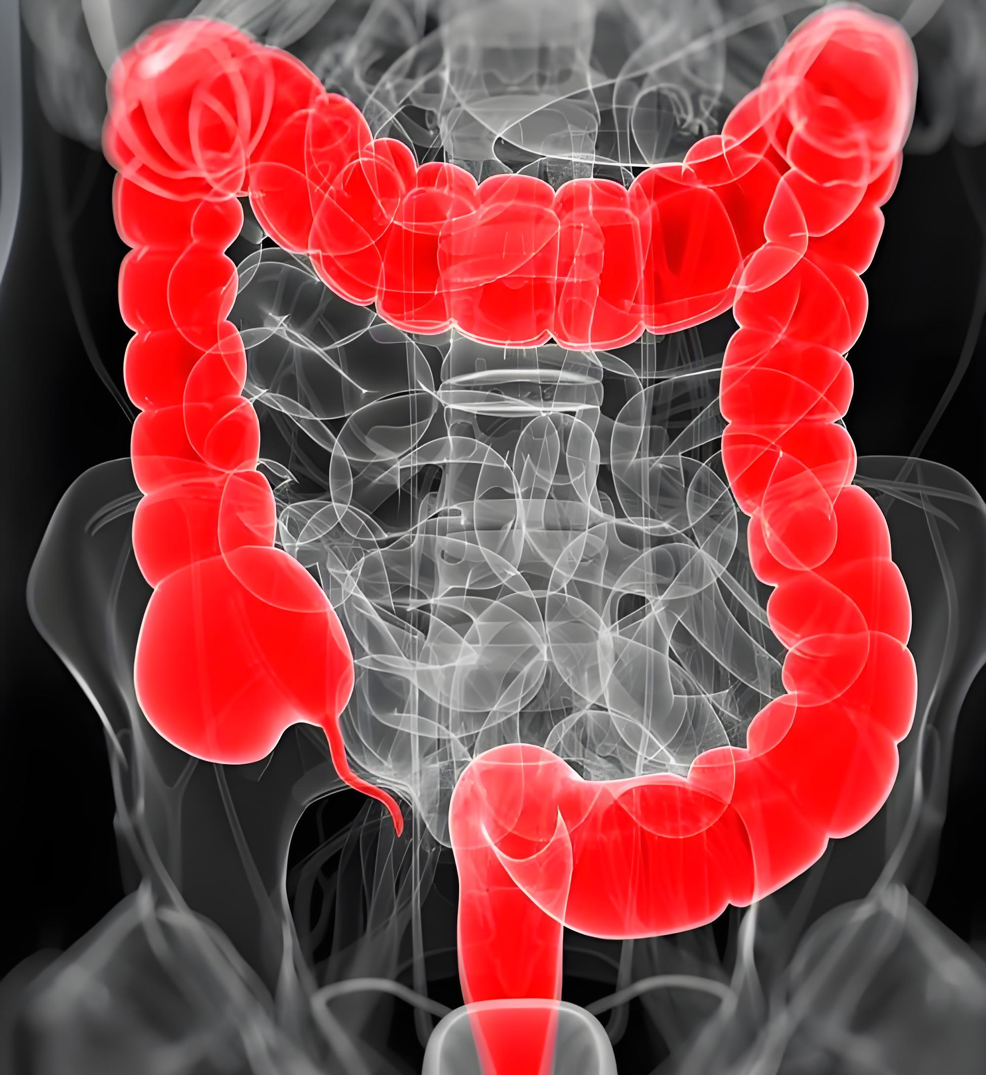 结直肠癌代谢干预迎新方向！复旦大学发文揭示抑制有氧糖酵解分子路径