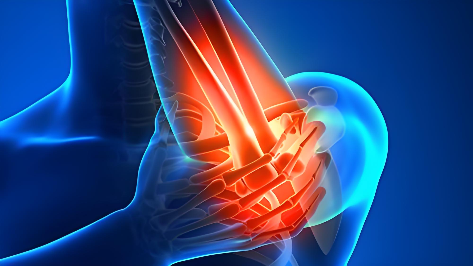 骨肉瘤诊疗迎突破！山大/郑大一附院团队证实：SPON2 可同时作为潜在生物标志物和治疗靶点