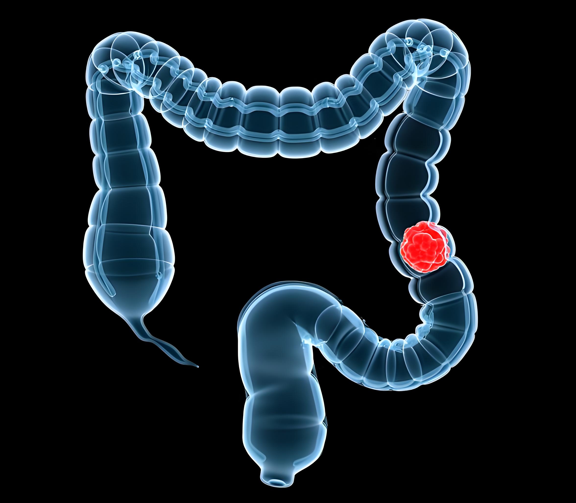 全球首次揭示！上海交通大学发文：结直肠癌进展的新机制