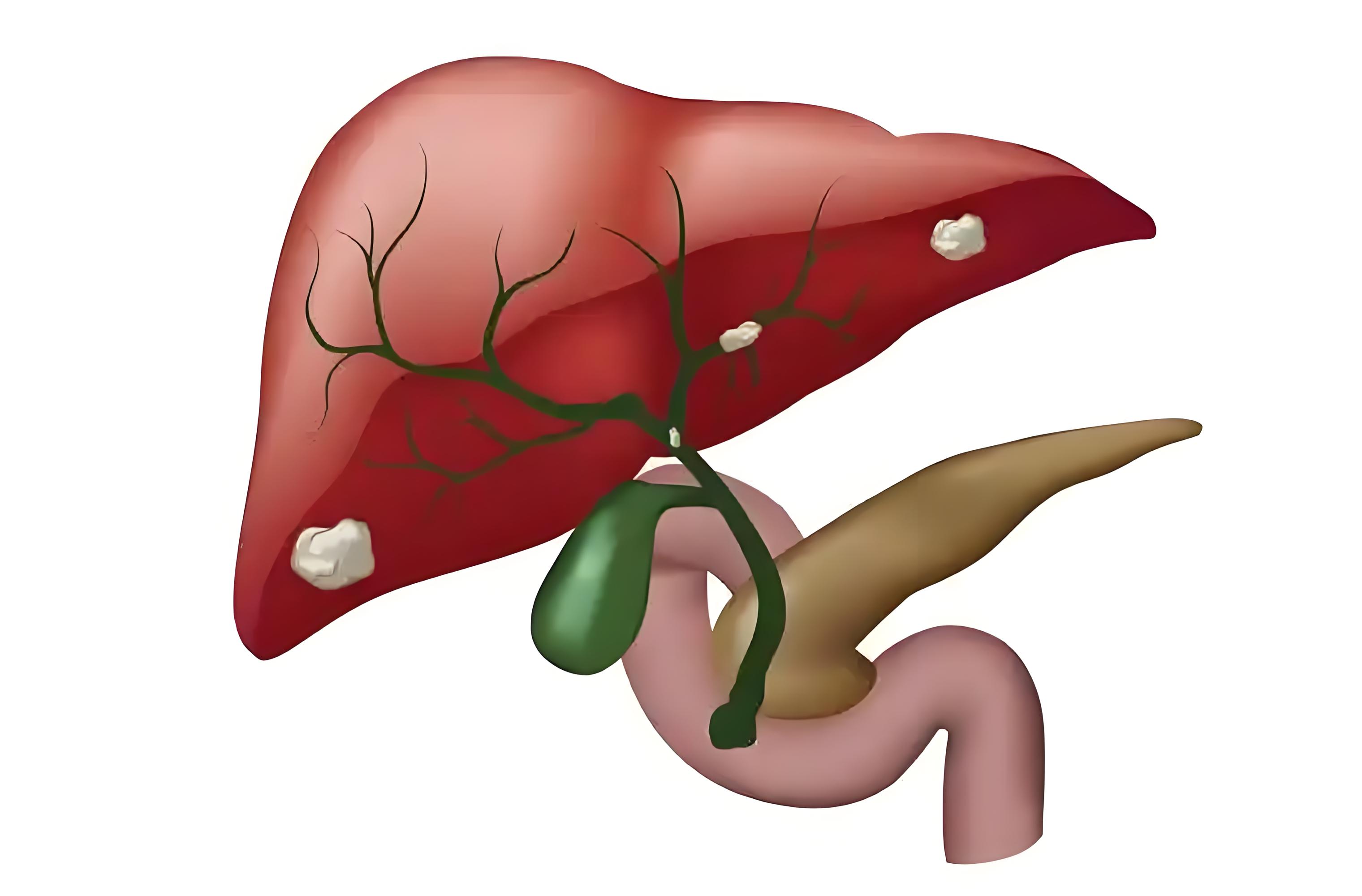 安全又有效！复旦大学樊嘉院士团队提出胆道癌联合治疗新策略