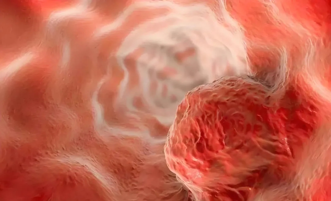 突破耐药困境！中国医学科学院开辟食管鳞癌治疗全新路径