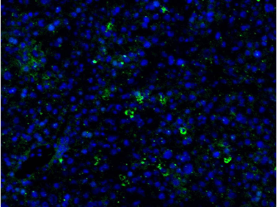 Hepatology：揭示癌细胞在肝脏中扩散转移的分子机理 